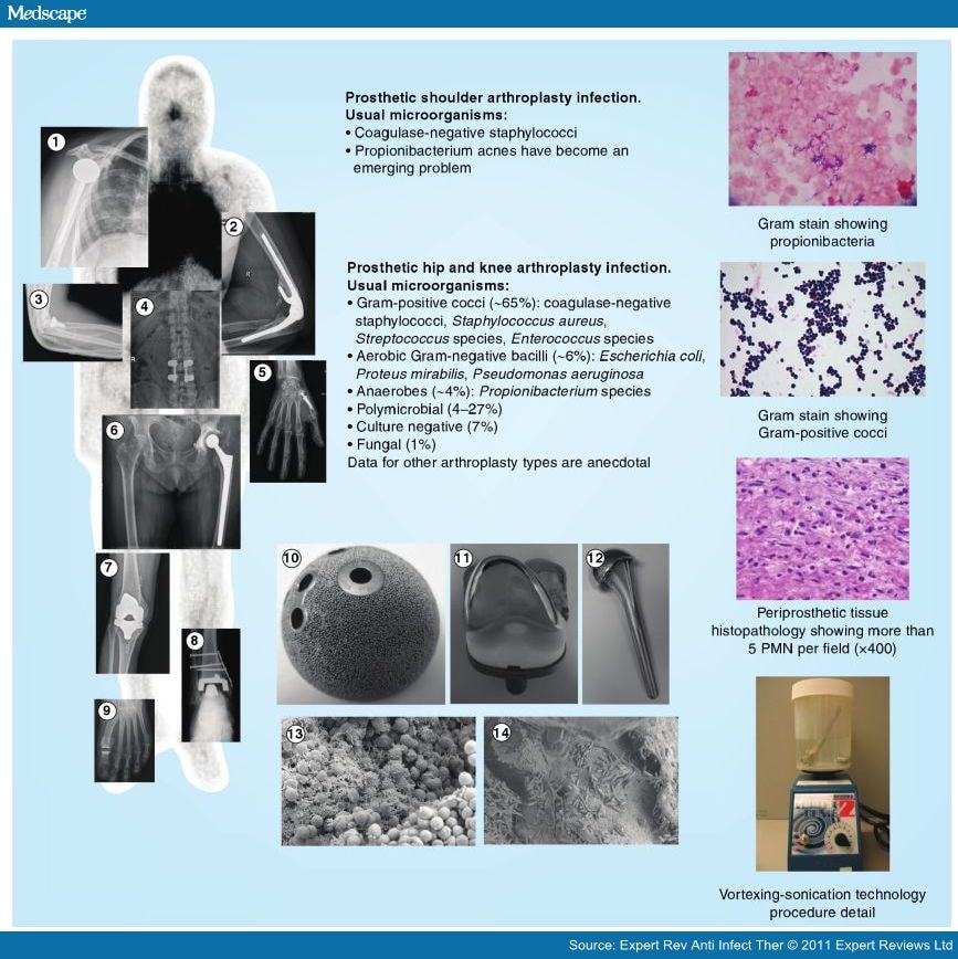 prosthetic-joint-infection-diagnosis-and-management