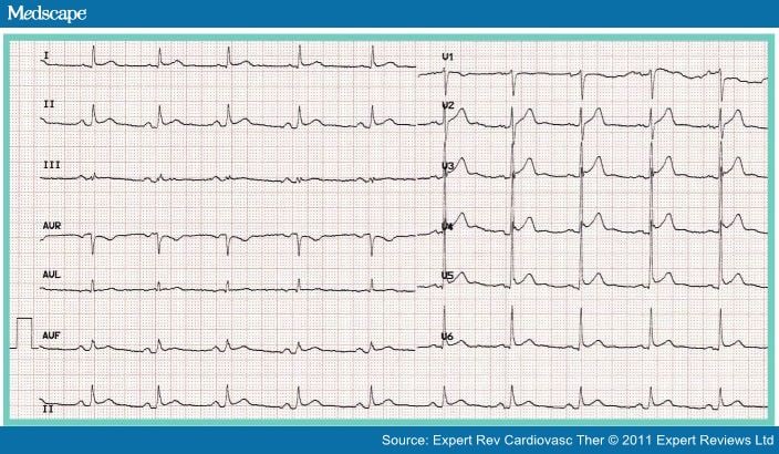 Evaluation and Management of Pericarditis - Page 4