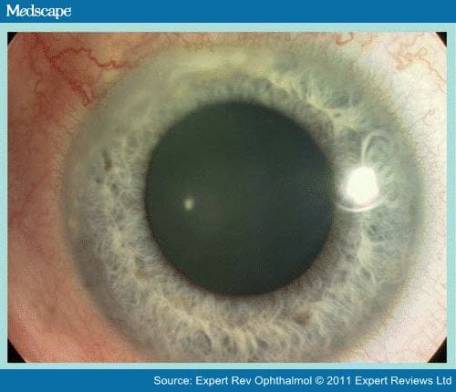 Ocular Manifestations of Wegener's Granulomatosis - Page 6