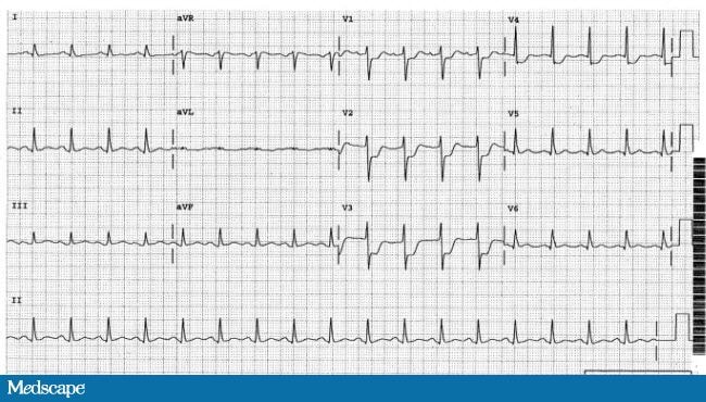 Which Part of the Heart Is Infarcted?