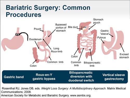 Obesity And Comorbid Conditions Clarifying The Bariatric Referral