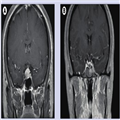 The Diagnosis and Management of Lymphocytic Hypophysitis