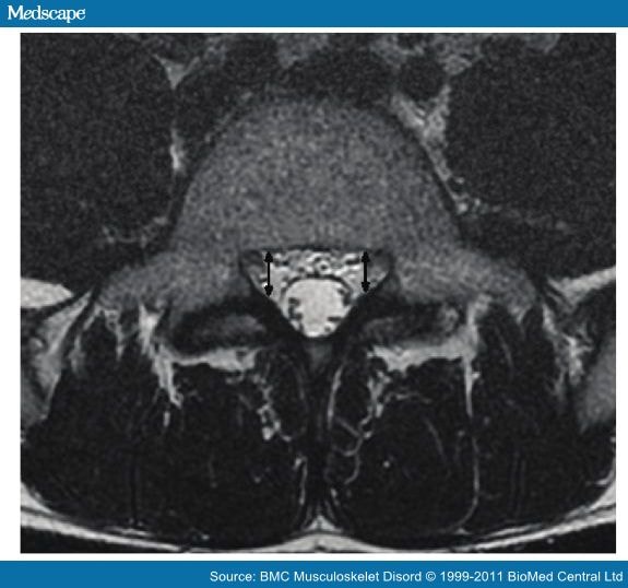 Radiologic Criteria for Diagnosis of Lumbar Spinal Stenosis - Page 4