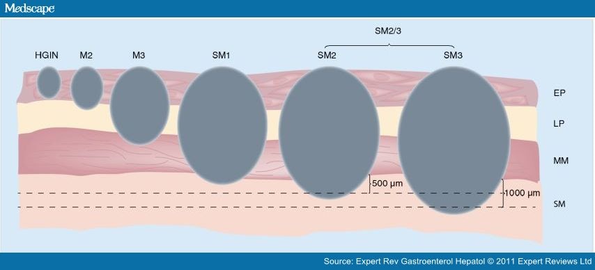 Endoscopy to Prevent and Treat Early Esophageal Neoplasia esophageal cancer diagram 