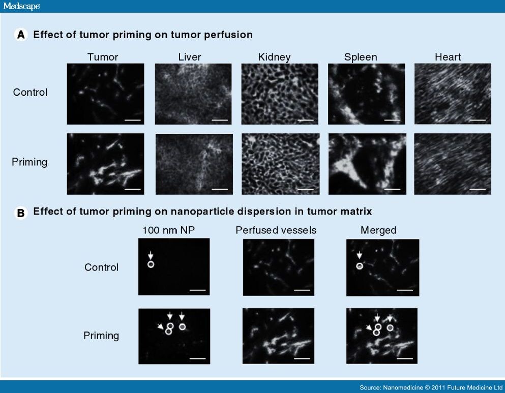 Improving Delivery Of Nanomedicines To Solid Tumors