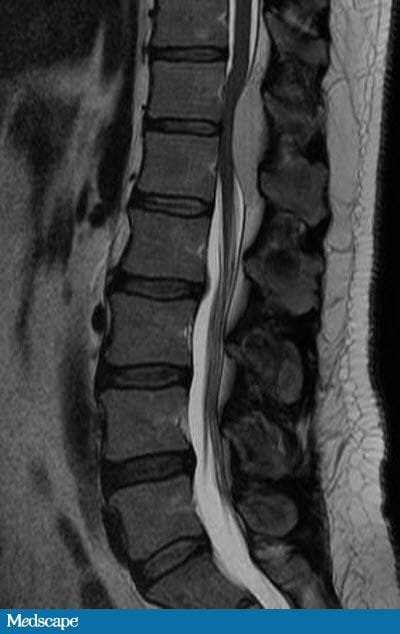 A 44-Year-Old Man With Progressive Weakness and Back Pain - Page 2