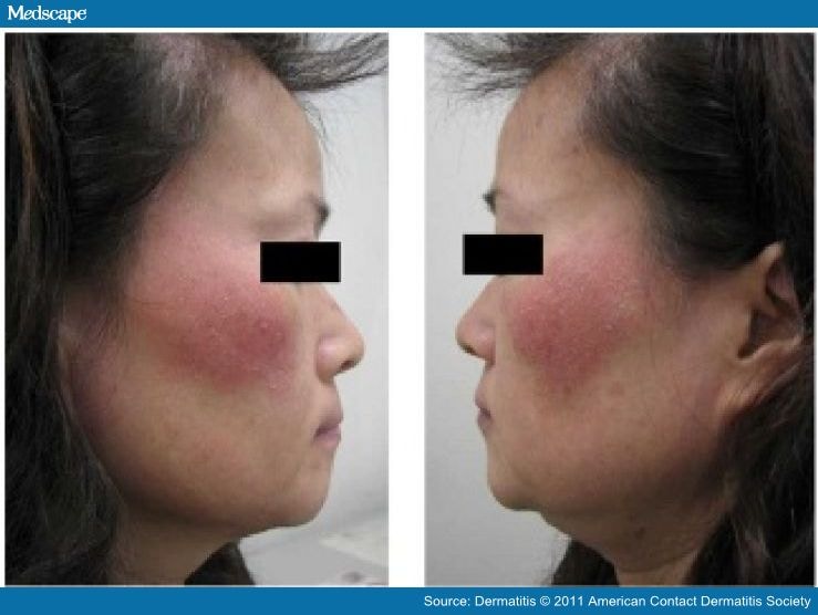 Allergic Contact Dermatitis from Carmine in Cosmetic Blush Page 2