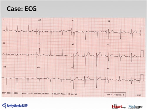 Antiarrhythmics for Atrial Fibrillation: Practical Implications of ...