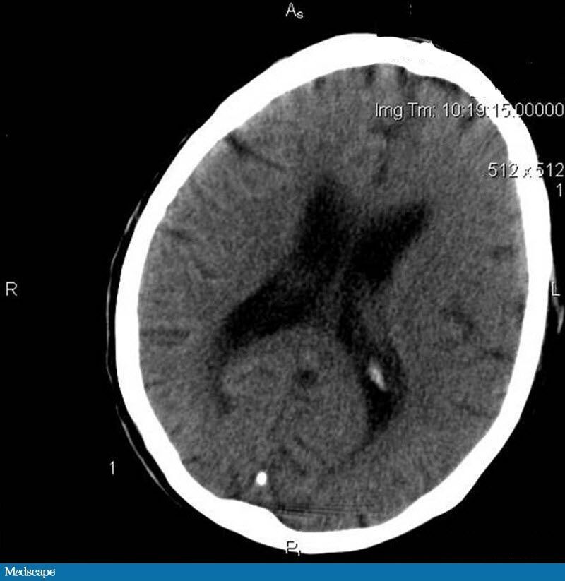 Severe Weakness And Speech Disturbance