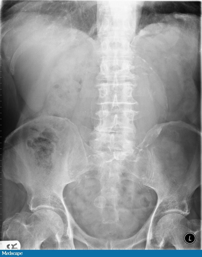 An 85-Year-Old With Sudden-Onset Severe Abdominal Pain