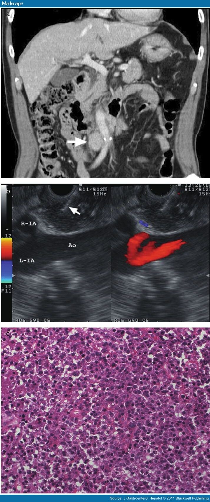 EUSFNA of Lesions Near the Aortoiliac Bifurcation Page 2