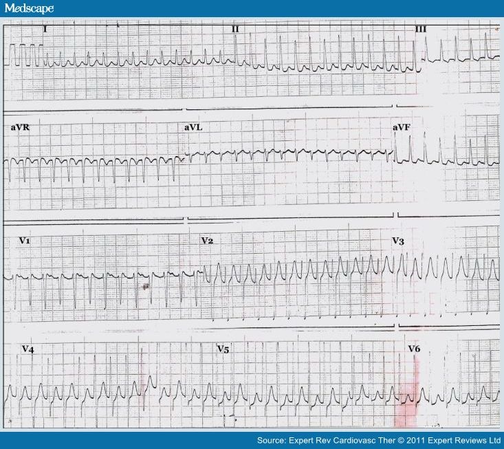 ECG Findings Associated With Cocaine Use in Humans