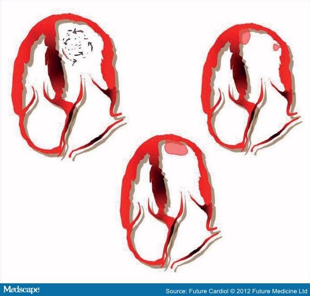 Lv Apical Mural Thrombus