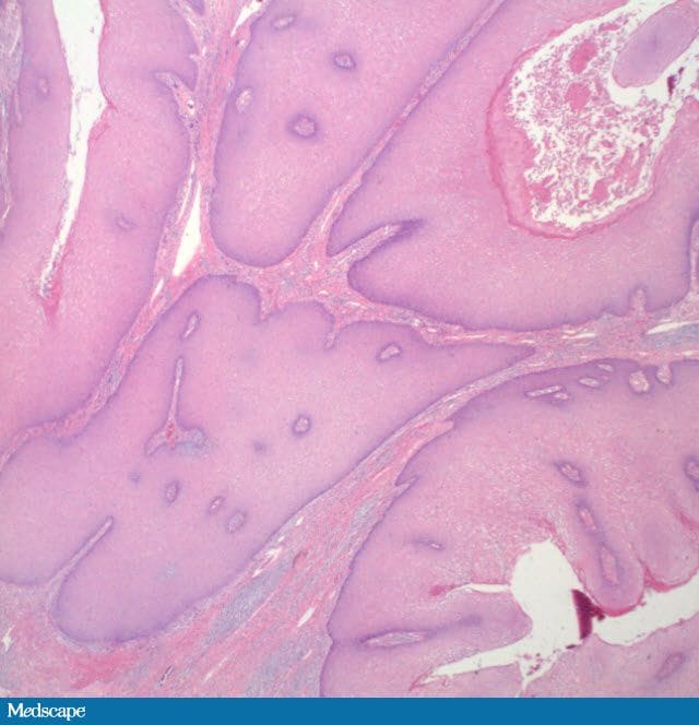 Giant Condyloma Of Buschke Lowenstein An Atypical Case