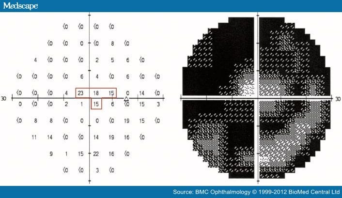 Open Blind Reference Blindness From Open-angle Glaucoma - Page 3