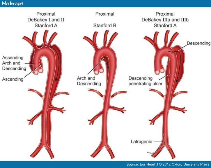 Management of Acute Aortic Syndromes