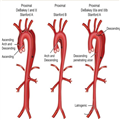 Management of Acute Aortic Syndromes