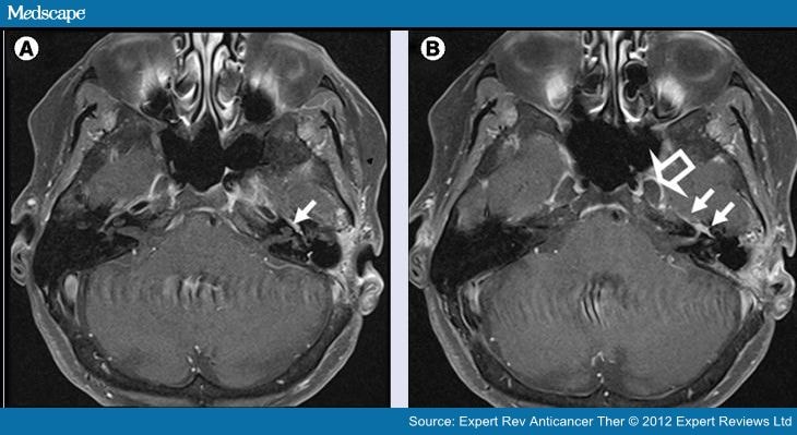 Perineural Invasion And Spread In Head And Neck Cancer - Page 3