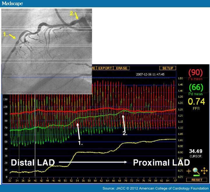 Functional Measurement of Coronary Stenosis