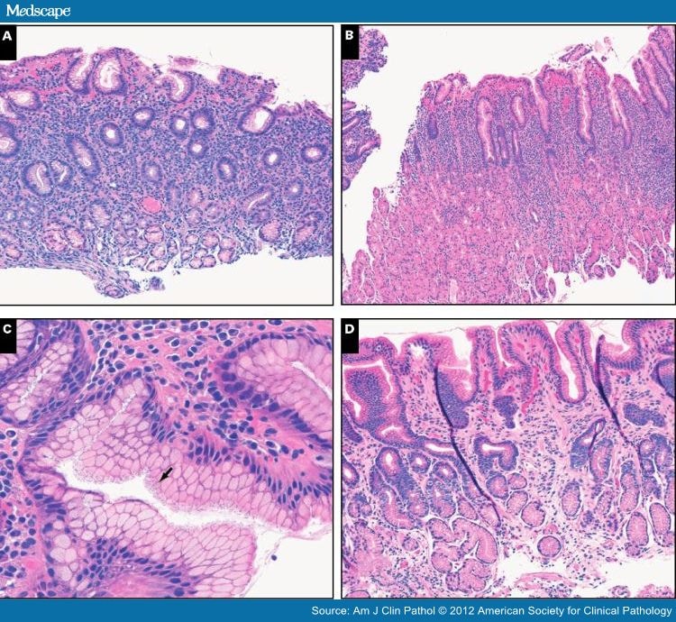 Diagnosing Helicobacter Infection in Gastric Biopsy Specimens