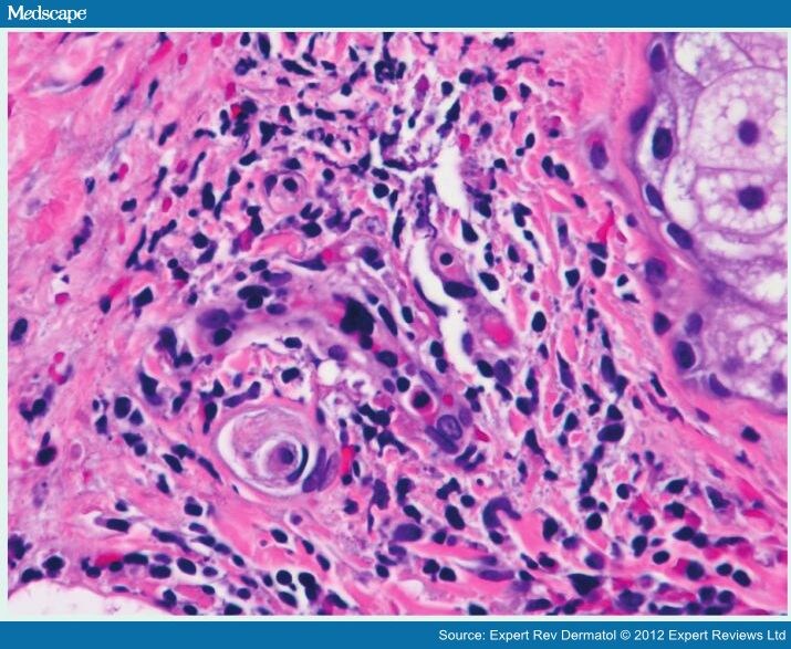 Dermatopathology of Rheumatologic Diseases