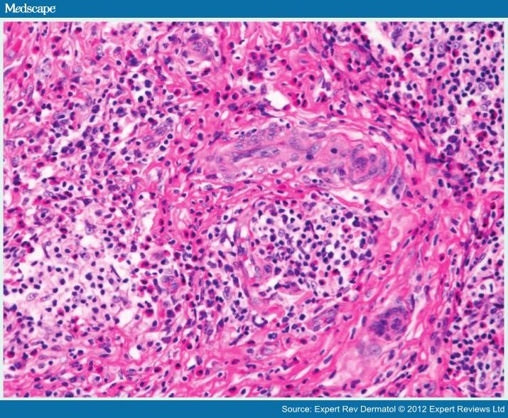 Dermatopathology of Rheumatologic Diseases