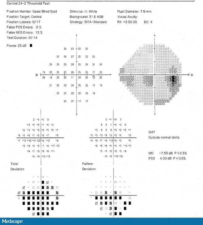 dm 2 with ocular complications icd 10