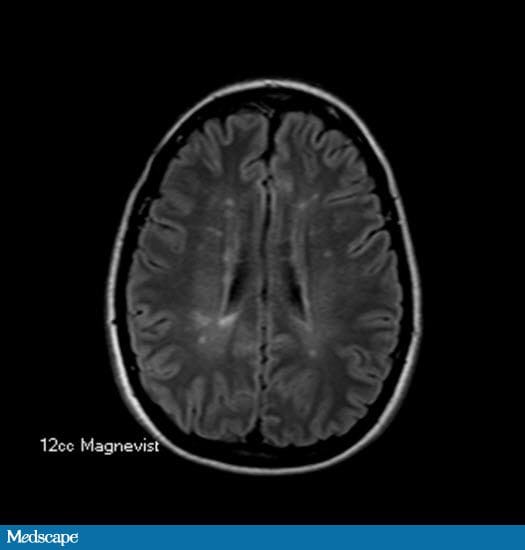 Acute Painless Monocular Vision Loss Page 2