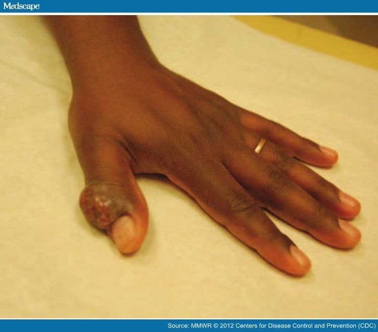 Orf Skin / PPT - ORF DISEASE PowerPoint Presentation, free download ...