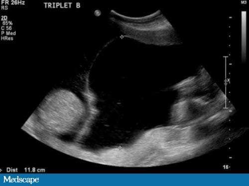 Dangerous Findings in a Multifetal Gestation