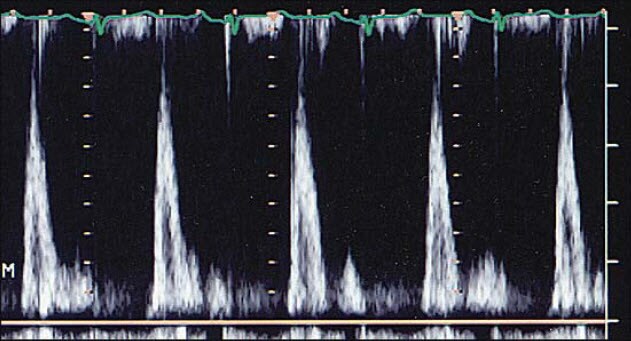 PAH vs PVH: A Tale of 2 Ventricles