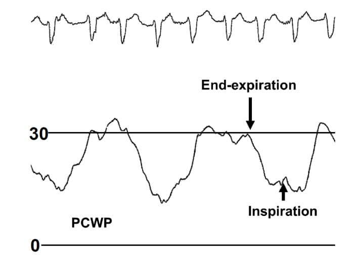 PAH vs PVH A Tale of 2 Ventricles