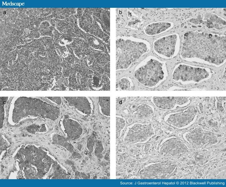 Primary Hepatic Neuroendocrine Carcinomas: Features and Outcomes - Page 3