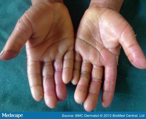 Acral Peeling Skin Syndrome in Two East-African Siblings - Page 3