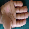 Acral Peeling Skin Syndrome in Two East-African Siblings - Page 3