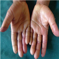 Acral Peeling Skin Syndrome in Two East-African Siblings - Page 3