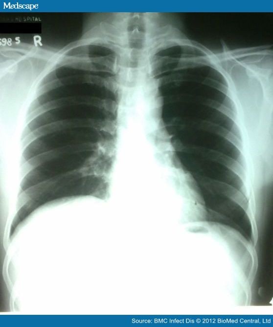 Diaphragmatic Paralysis - Page 3