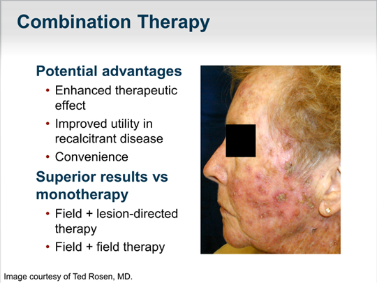 Paradigms In The Treatment Of Actinic Keratosis Transcript 0125