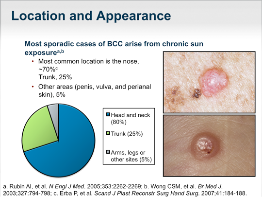 Diagnosis and Treatment of Basal Cell Carcinoma (Transcript)