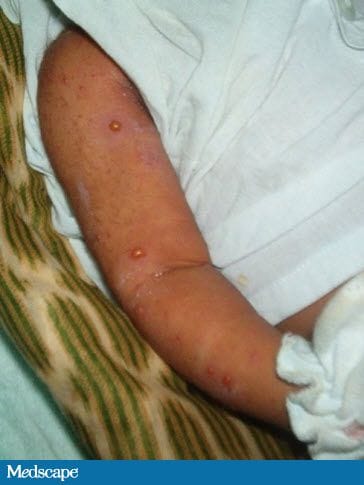 Vanicular Rash Advancing Vesicular Rash in a Neonate: What's the Diagnosis?