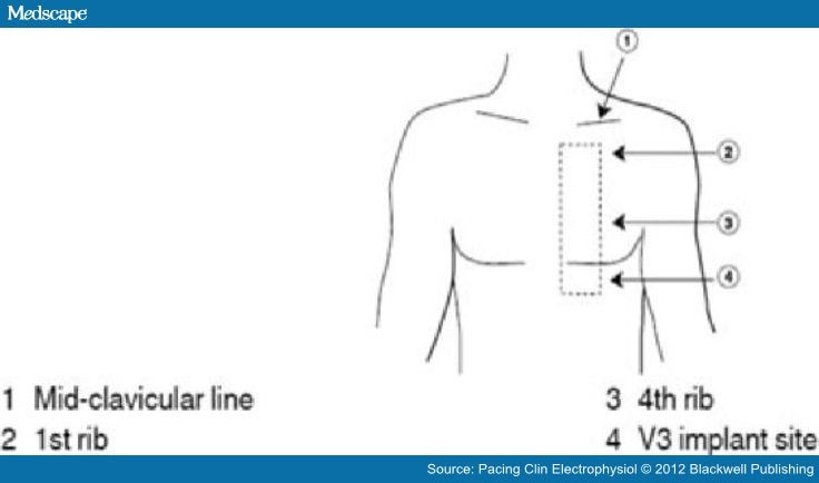 Indications for Implantable Cardiac Monitors