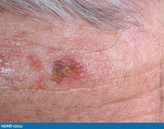 Cases in Actinic Keratosis, the Often Overlooked Condition