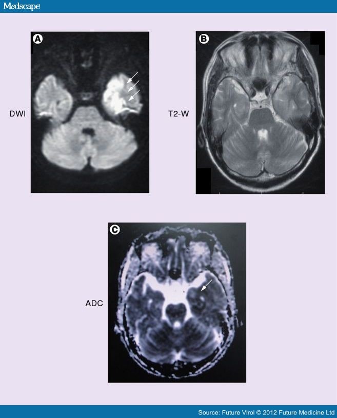 An Update On Diagnostic Imaging Studies For Viral Encephalitis - Page 3