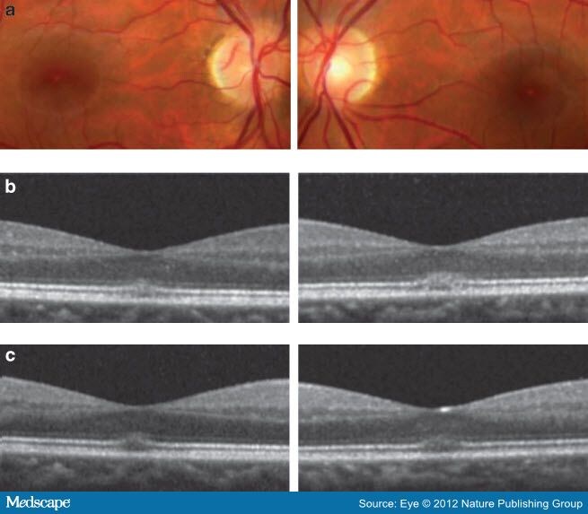 Adverse Ophthalmic Reaction in Poppers Users: Case Series of 