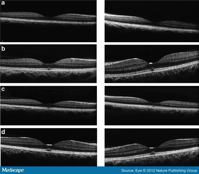 Adverse Ophthalmic Reaction In Poppers Users Case Series Of Poppers