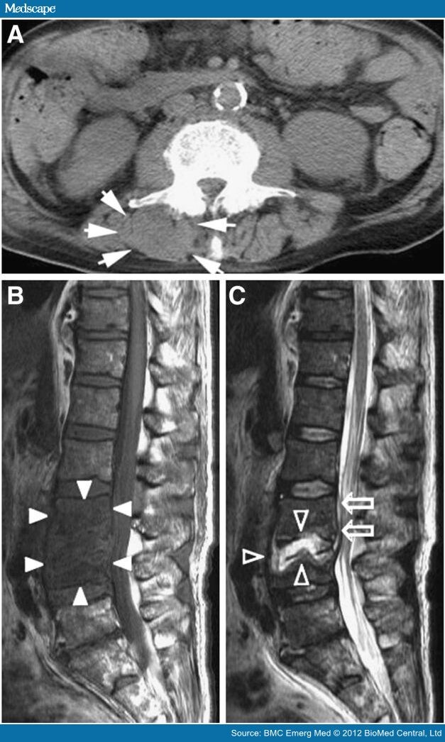 SCJ Septic Arthritis After Spondylodiscitis in a Diabetic