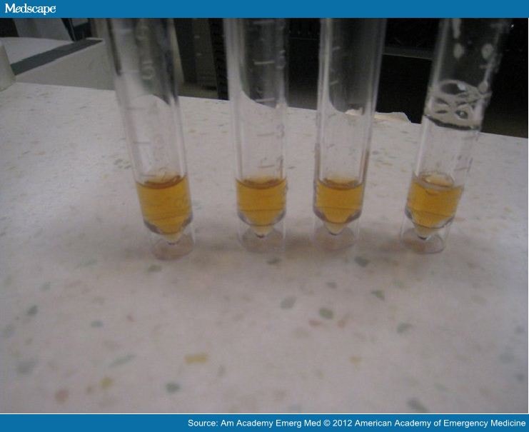 xanthochromic csf