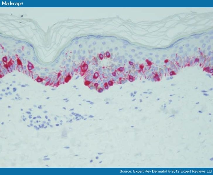 Accurate Identification of Melanoma Tumor Margins