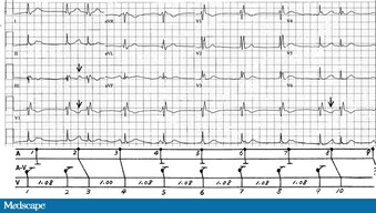 33+ Junctional Rhythm With Right Bundle Branch Block Pics