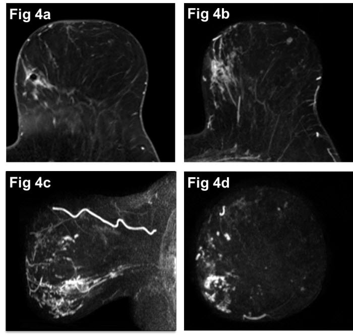 Breast Cancer Imaging Mris Role In Current Practice 1695